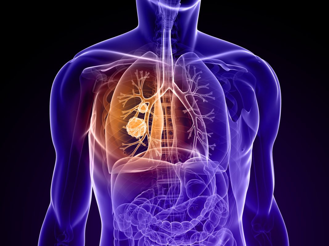 Have you or a loved one been diagnosed with Lung Cancer or Mesothelioma?